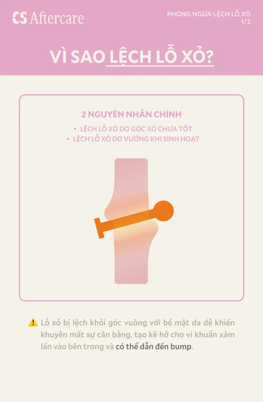 Vì sao lệch lỗ xỏ — 2 nguyên nhân chính